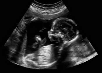 obstetrisk ultralyd ,medisinsk ,medisinsk avbildning ,radiologi.